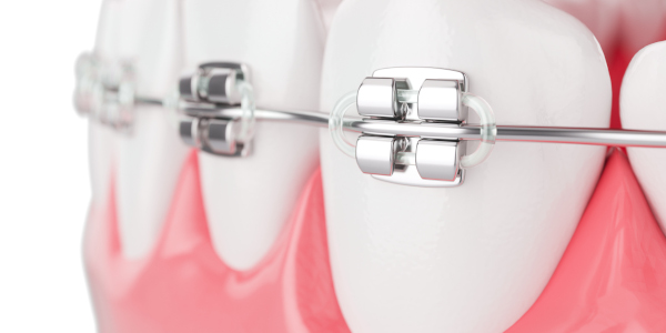 Brackets