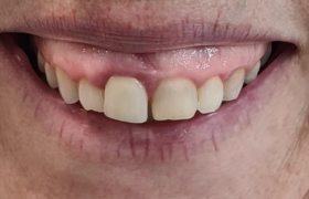 cas alignement + couronne - vue bouche  avant