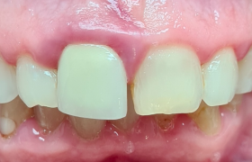 cas alignement + couronne - vue intraorale avant
