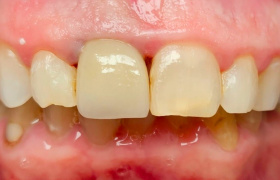 cas alignement + couronne - vue intraorale apres