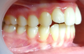 patient 1 - alignement - vue droite 