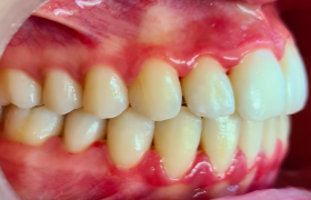 patient 1 - alignement - vue droite