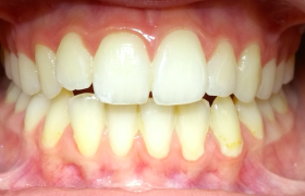 patient 1 - alignement - vue face