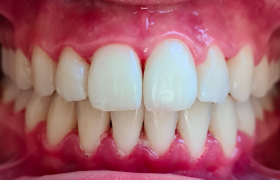 patient 1 - alignement - vue face