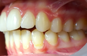 patient 1 - alignement - vue gauche