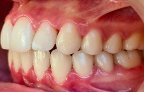 patient 1 - alignement - vue gauche
