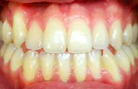patient 2 - alignement - vue face avant