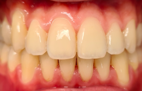 patient 2 - alignement - vue face apres